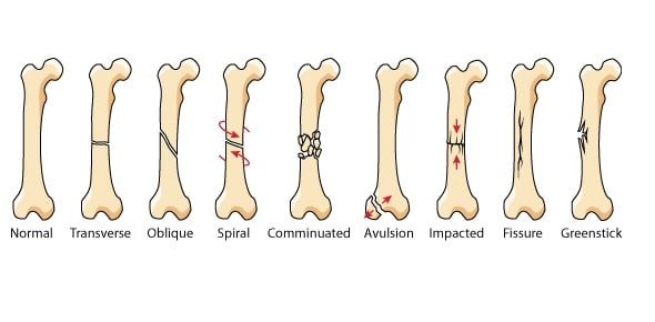 What Are Various Types of Bones Fracture Flashcards Flashcards by ProProfs